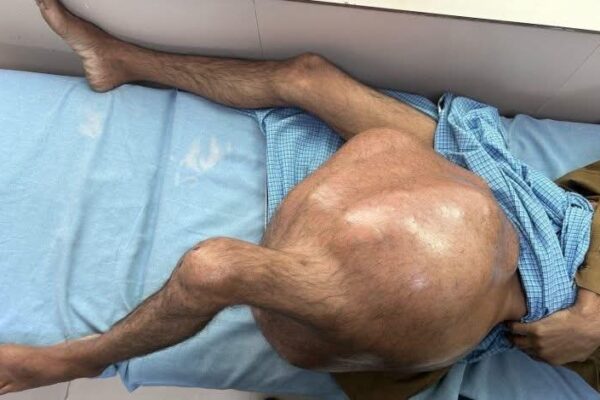 Rishikesh: ऋषिकेश में एम्स डॉक्टरों ने 35 किलो का बोन ट्यूमर हटाकर रचा नया रिकॉर्ड